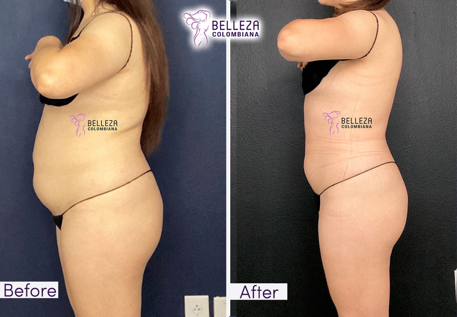 Body Countouring Before & After