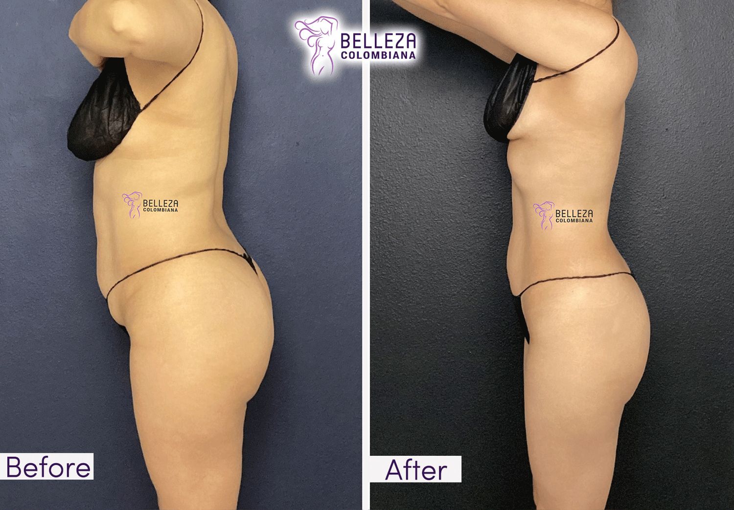 Body Countouring Before & After