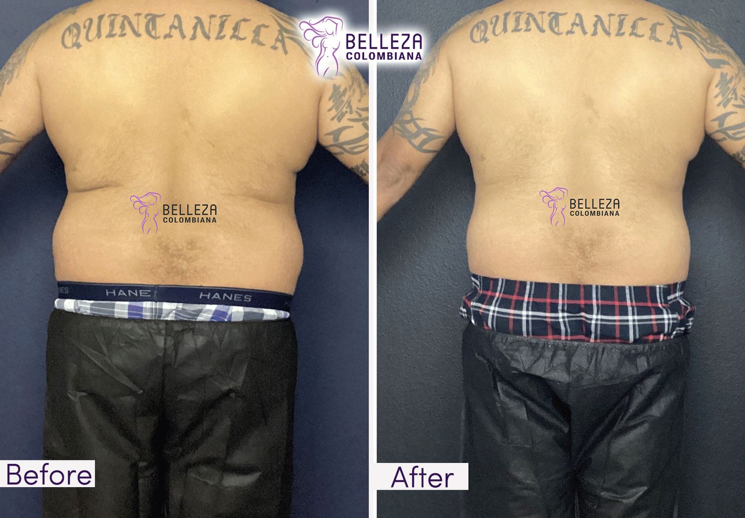 Body Countouring Before & After