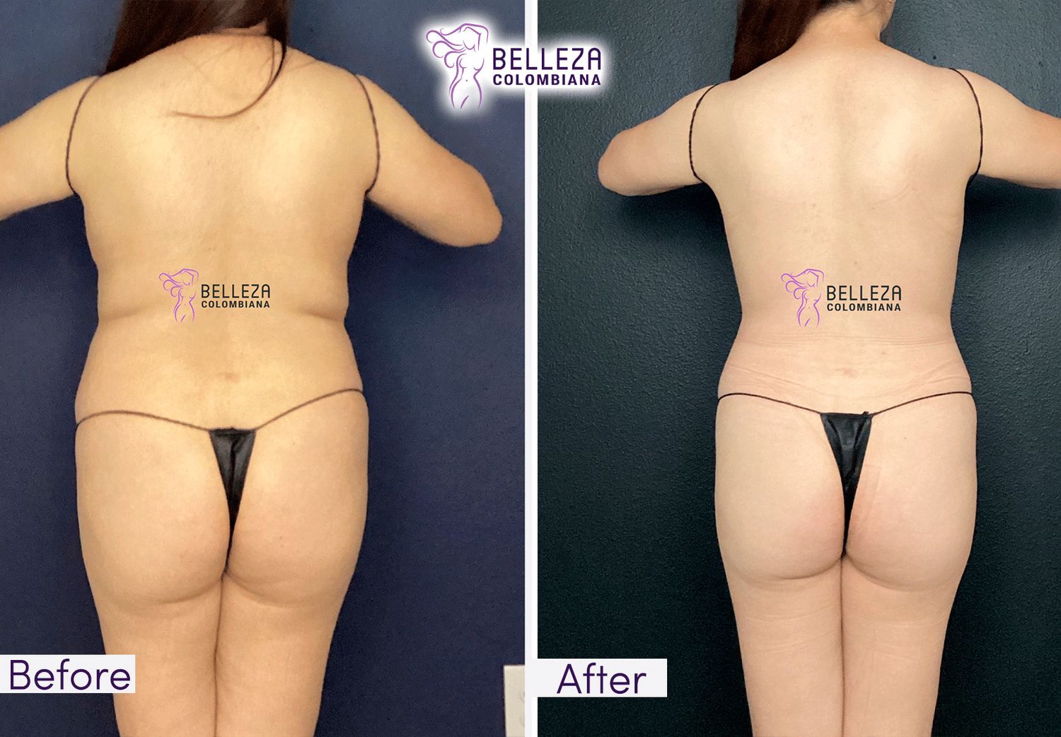 Body Countouring Before & After