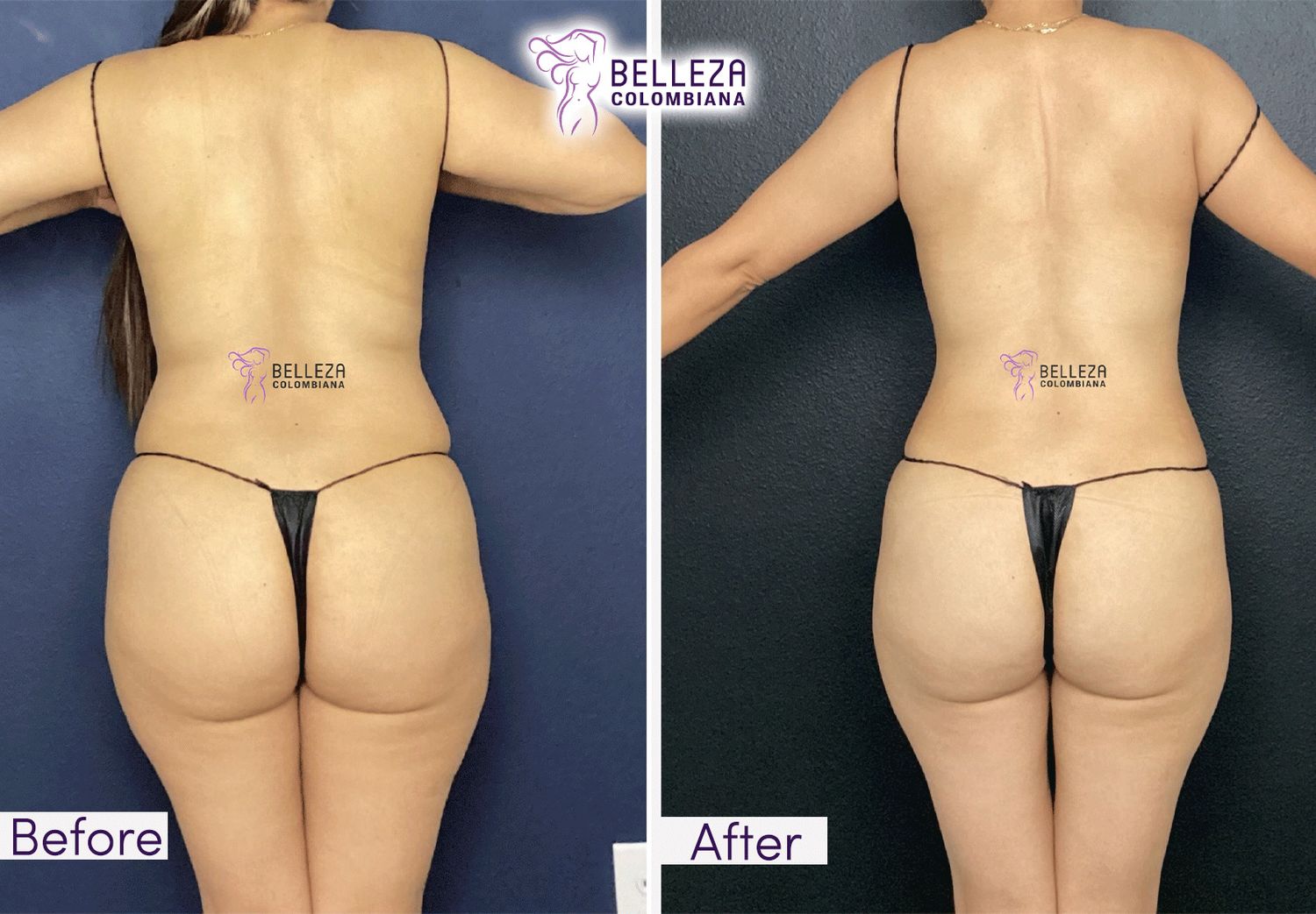 Body Countouring Before & After