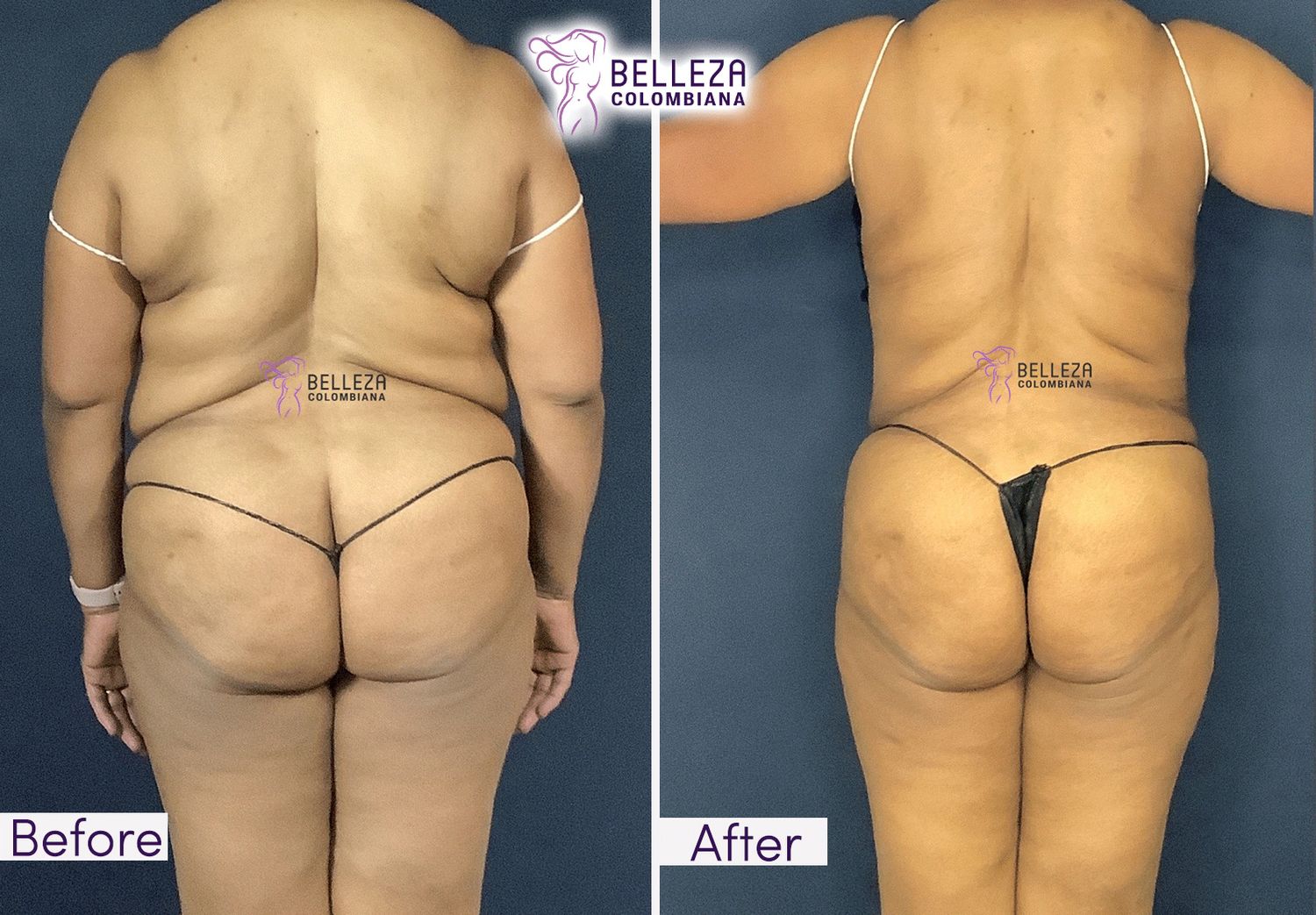 Body Countouring Before & After