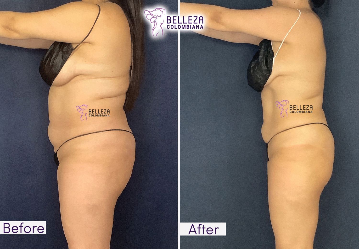 Body Countouring Before & After