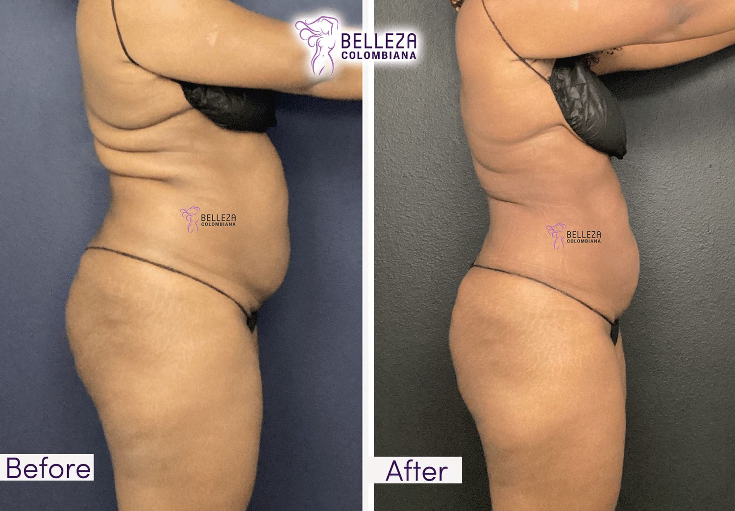 Body Countouring Before & After