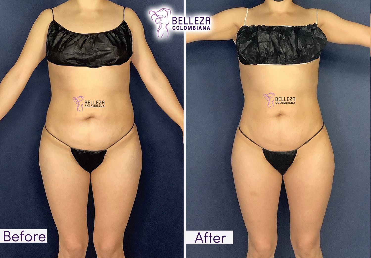 Body Countouring Before & After