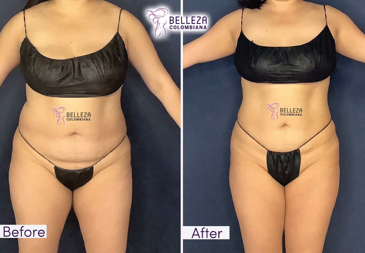 Body Countouring Before & After