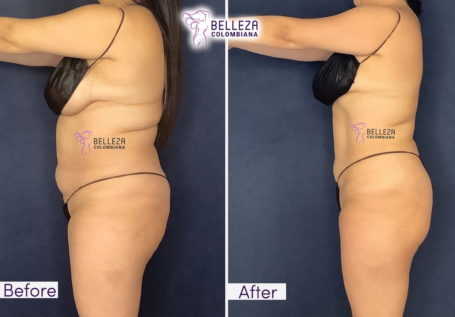 Body Countouring Before & After