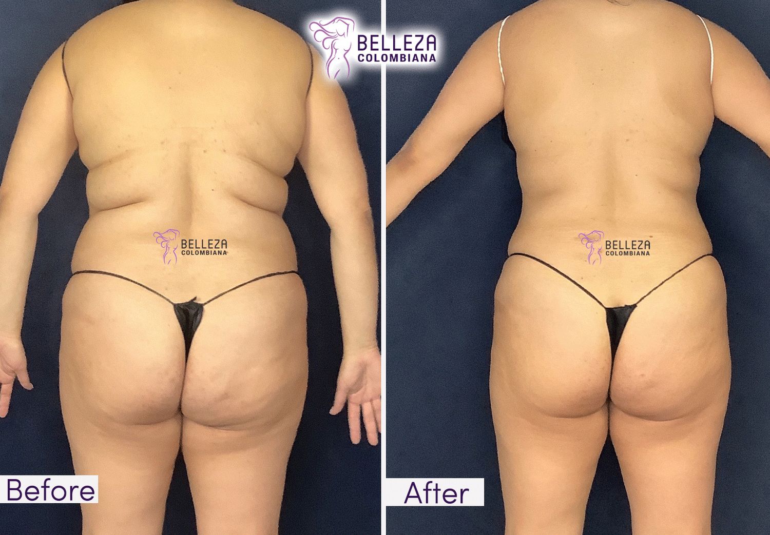 Body Countouring Before & After