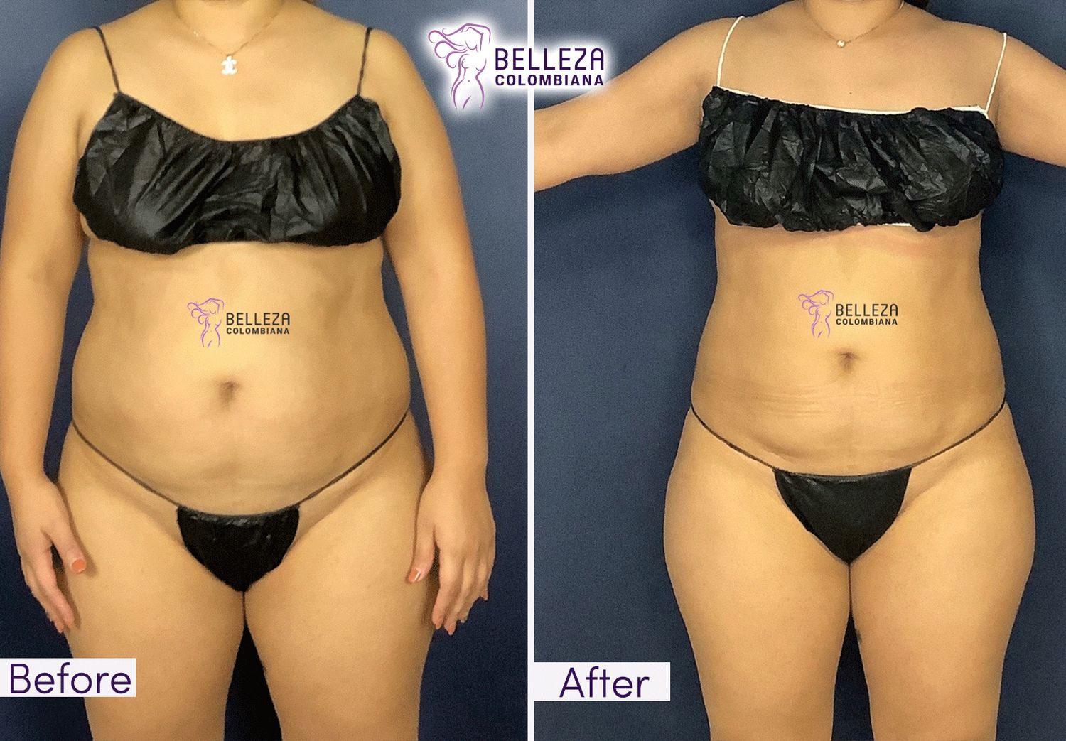 Body Countouring Before & After