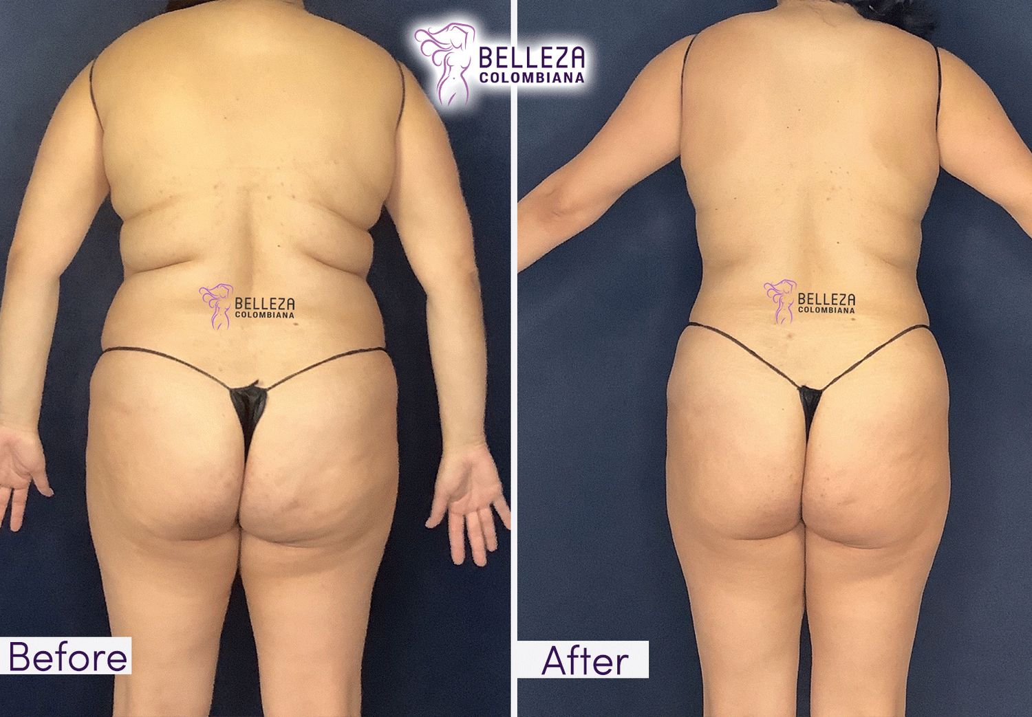 Body Countouring Before & After