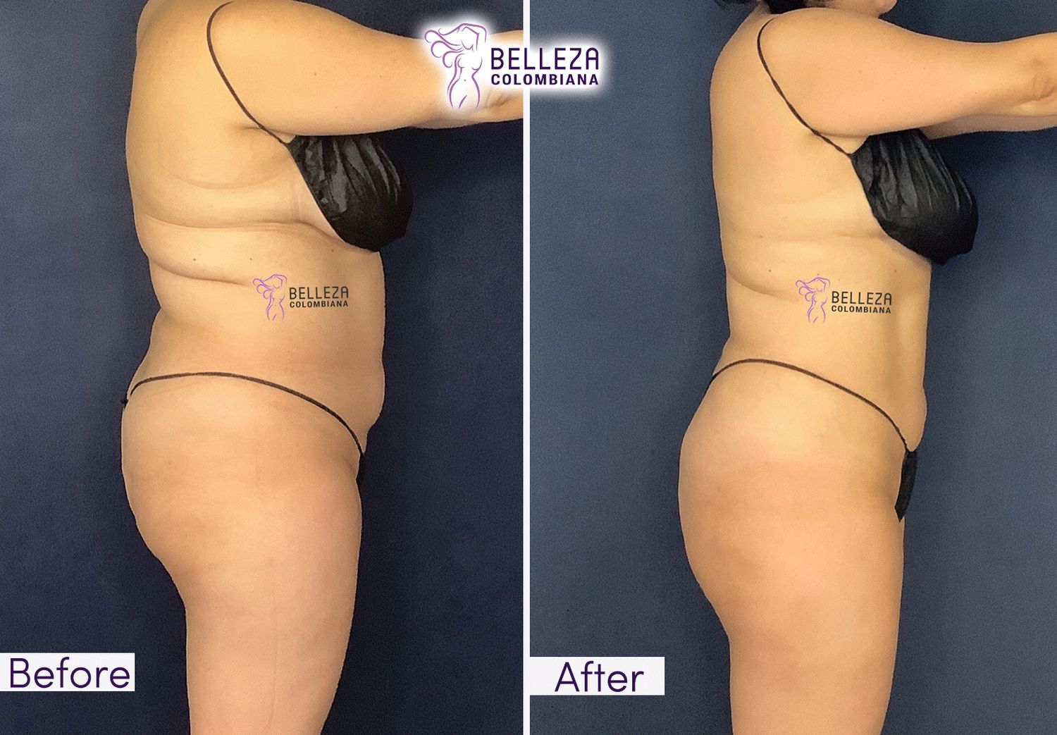 Body Countouring Before & After