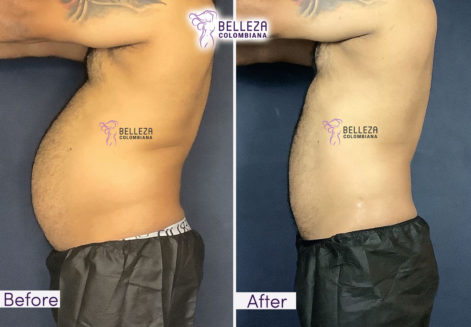 Body Countouring Before & After