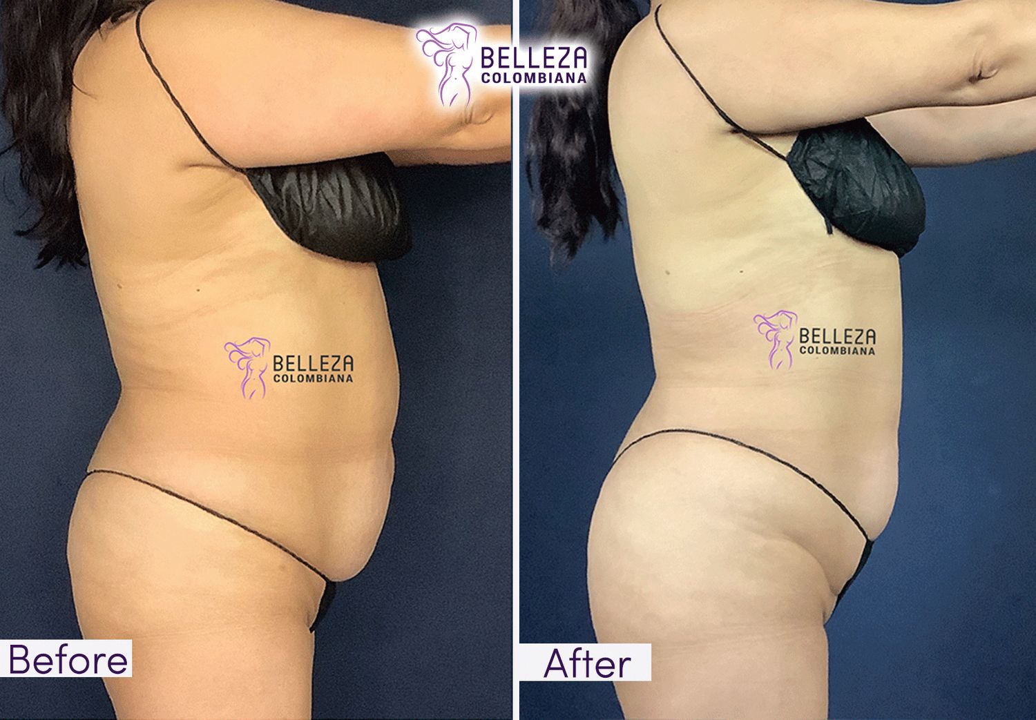 Body Countouring Before & After