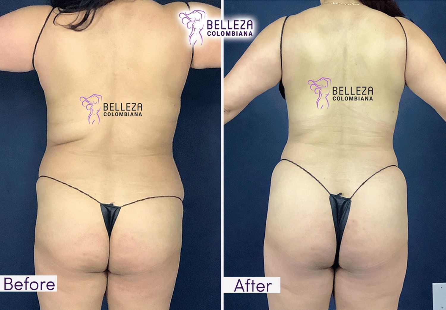 Body Countouring Before & After