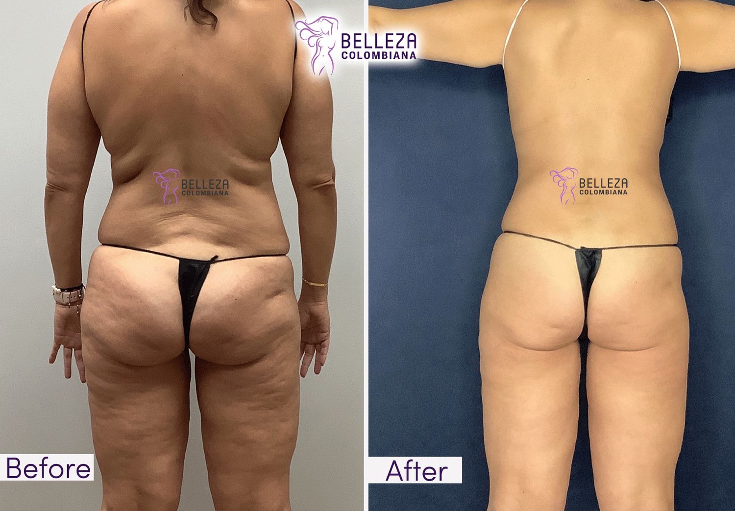 Body Countouring Before & After