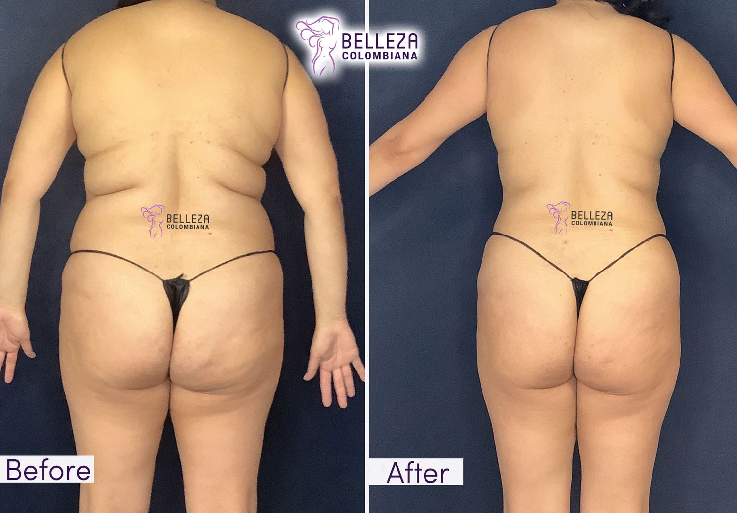 Body Countouring Before & After