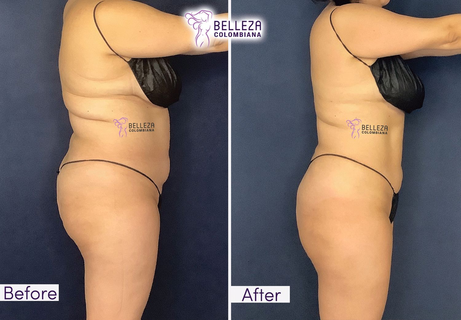 Body Countouring Before & After