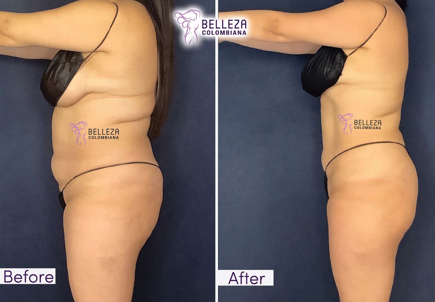 Body Countouring Before & After