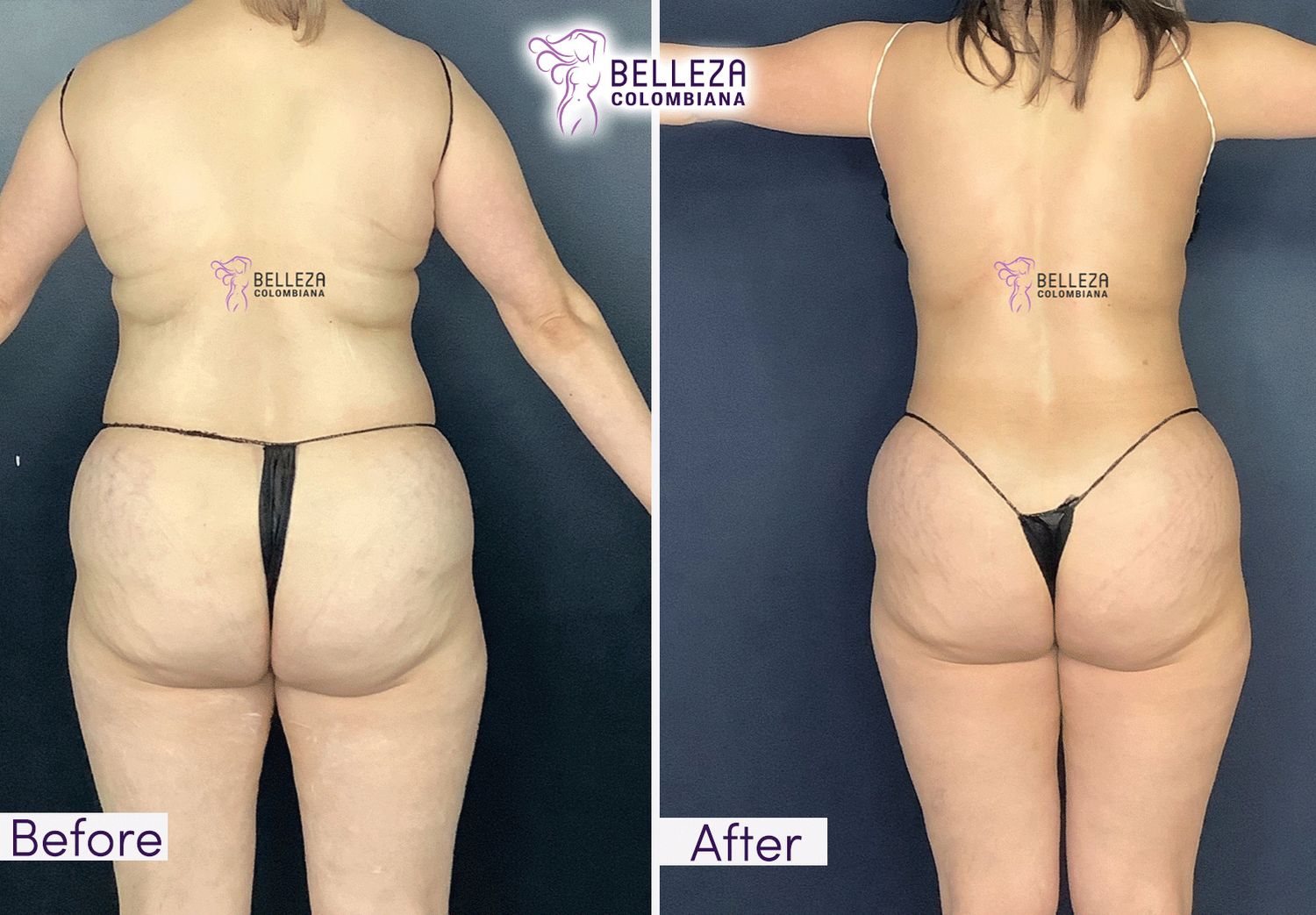 Body Countouring Before & After