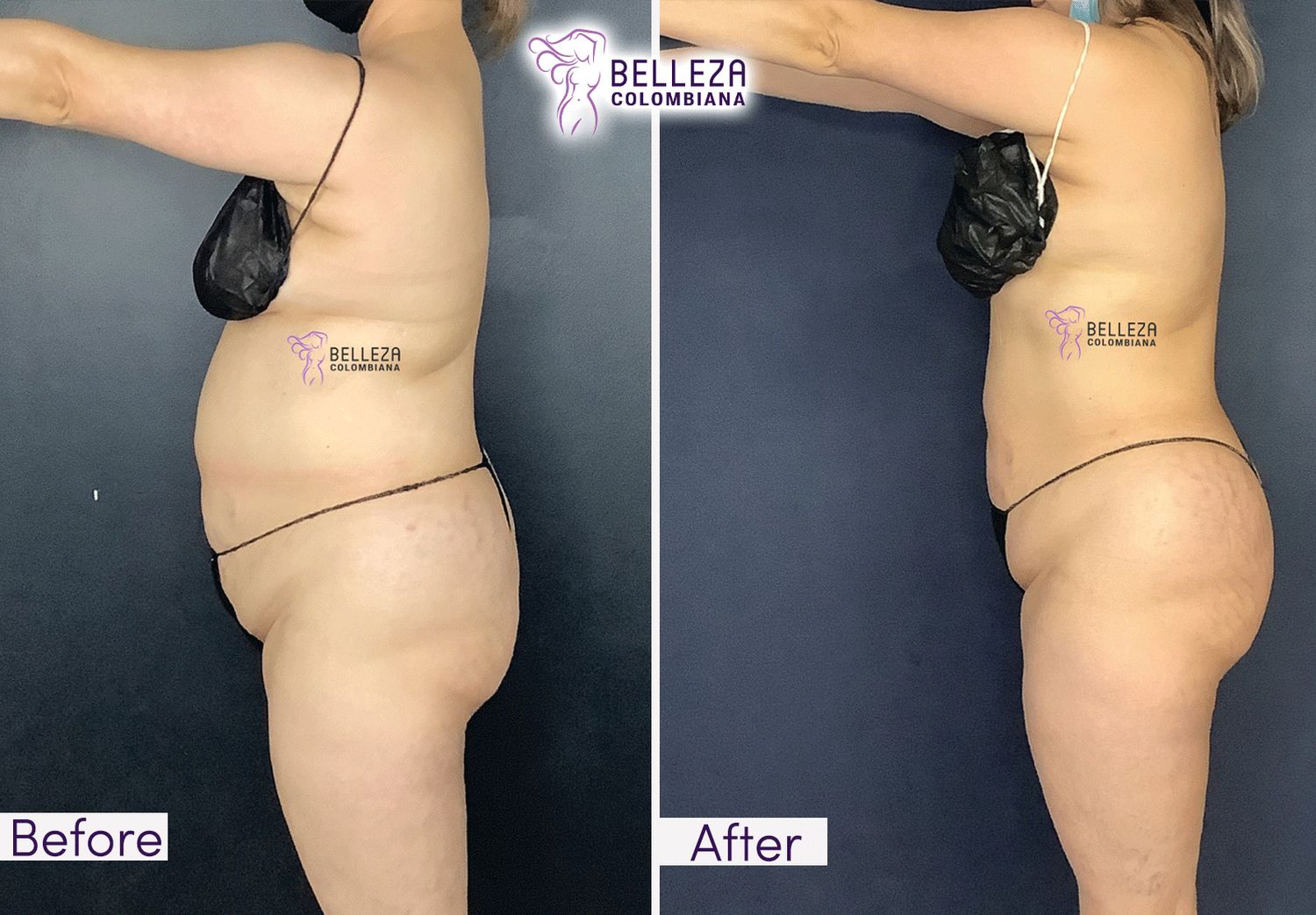 Body Countouring Before & After