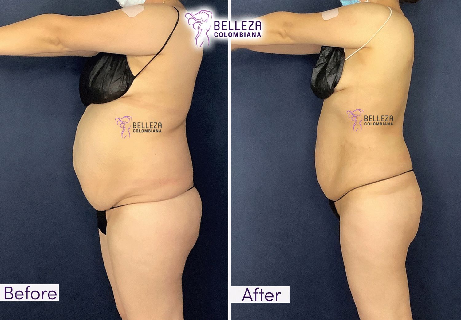 Body Countouring Before & After