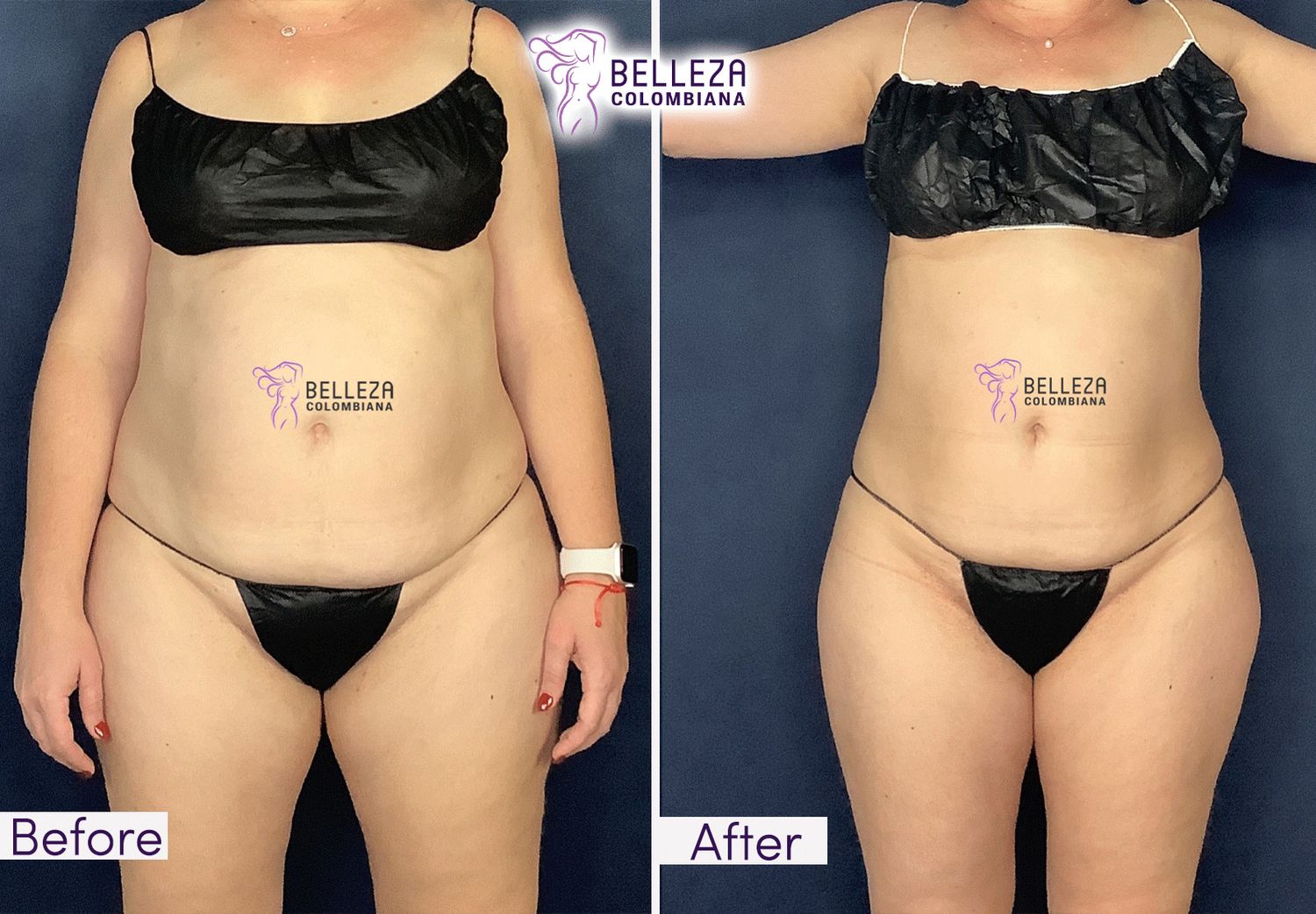 Body Countouring Before & After