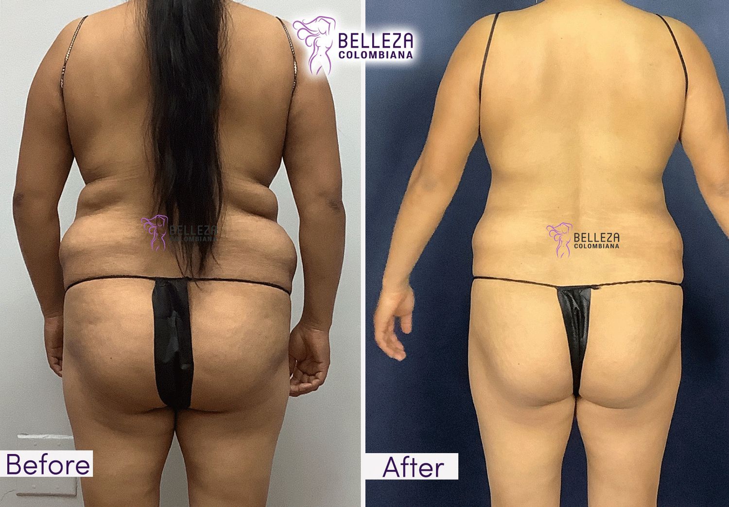 Body Countouring Before & After