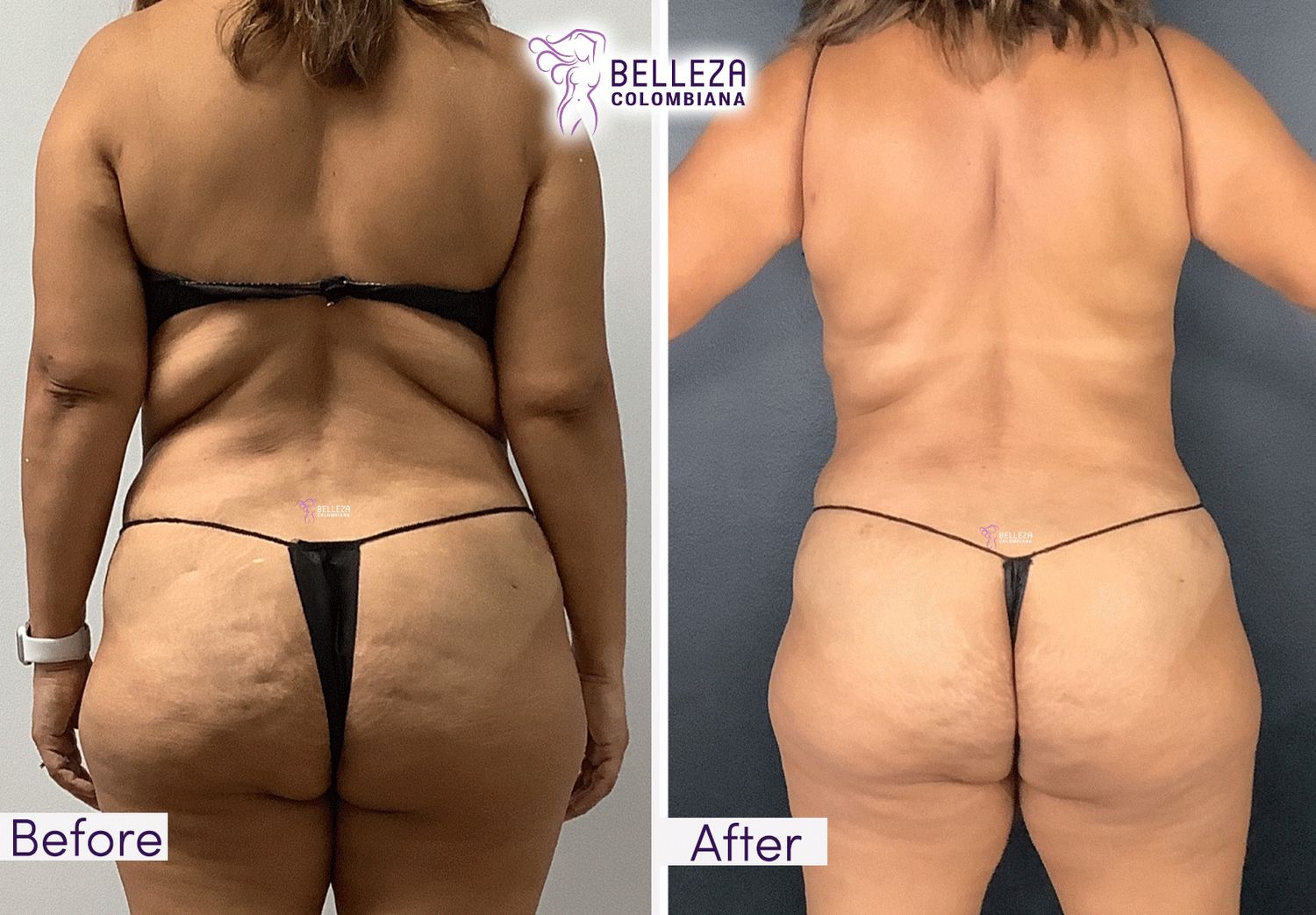 Body Countouring Before & After