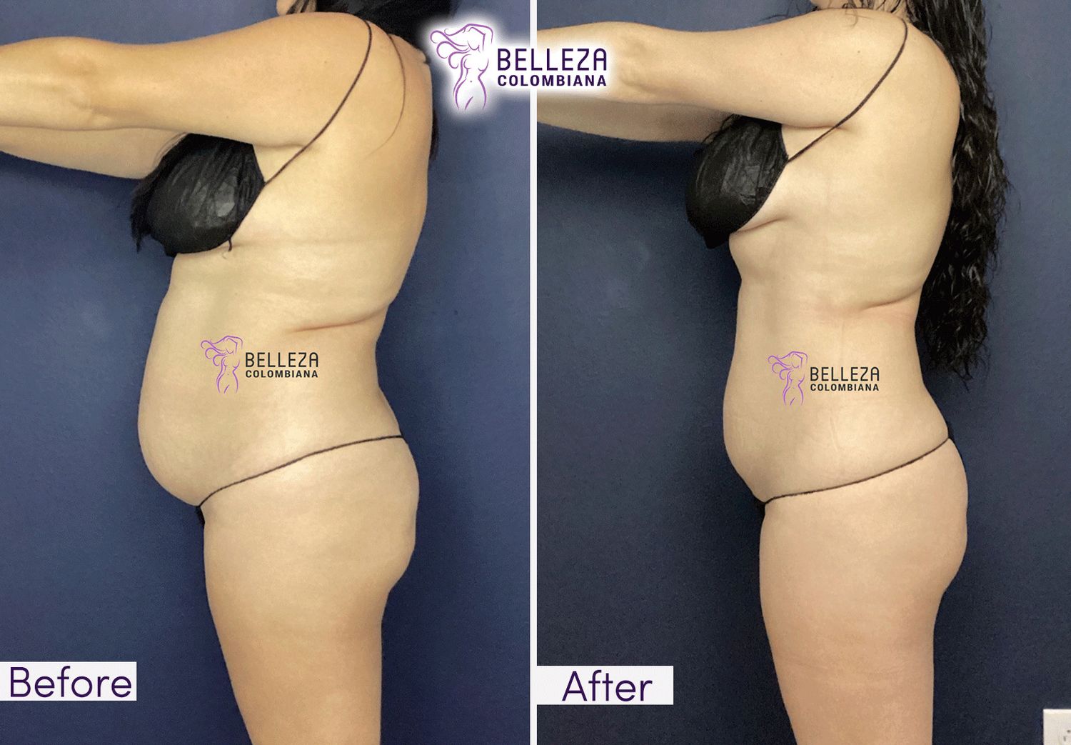 Body Countouring Before & After