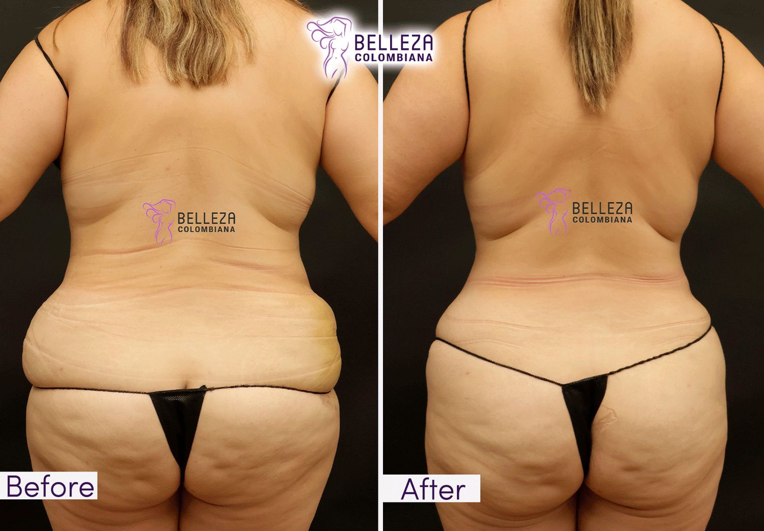 Body Countouring Before & After