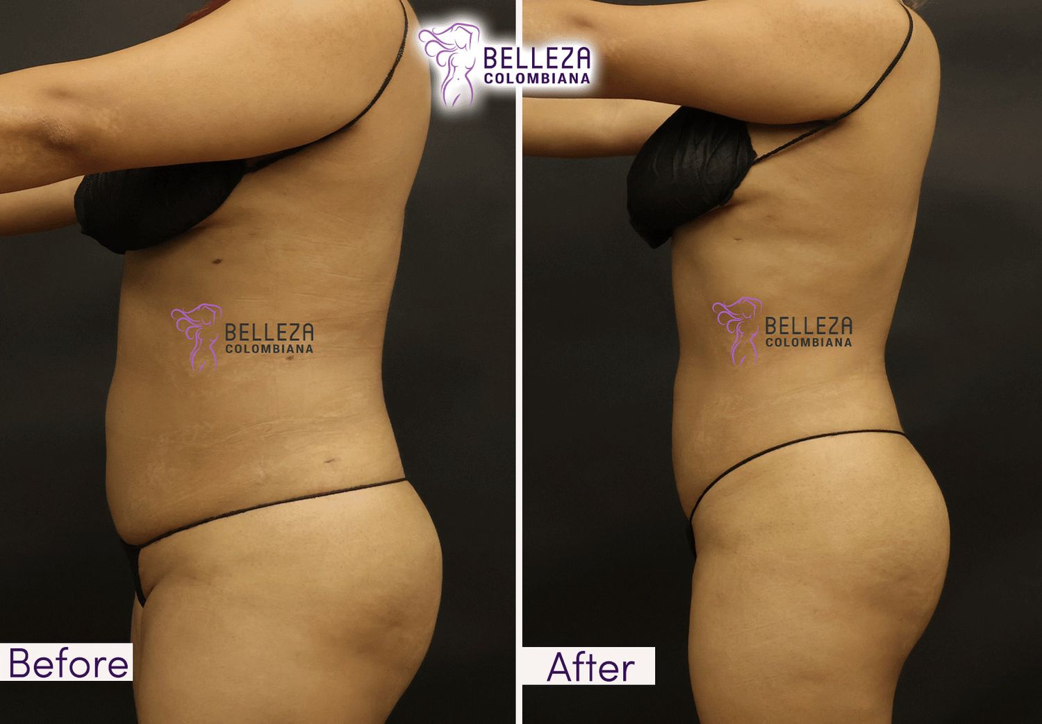 Body Countouring Before & After