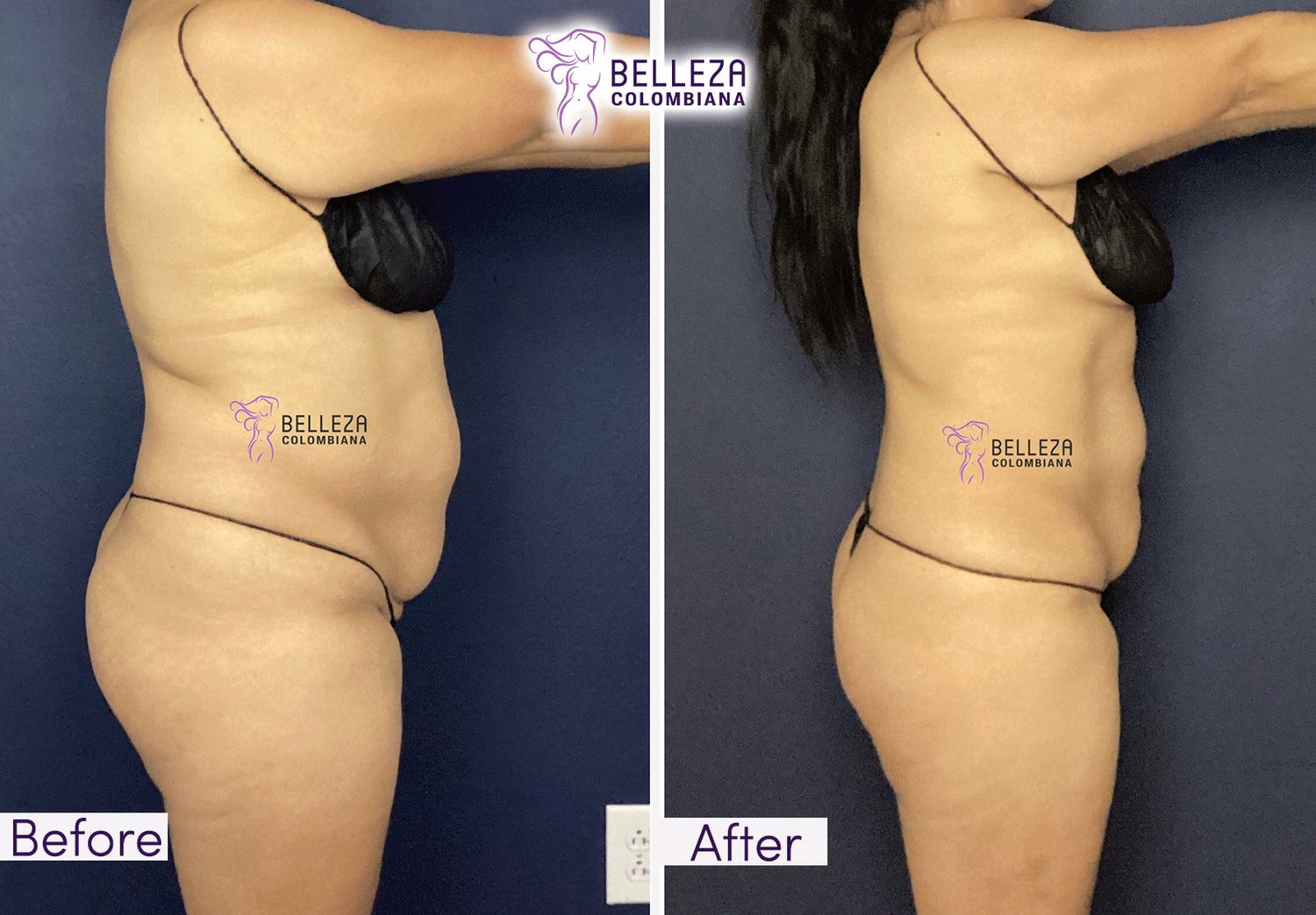 Body Countouring Before & After