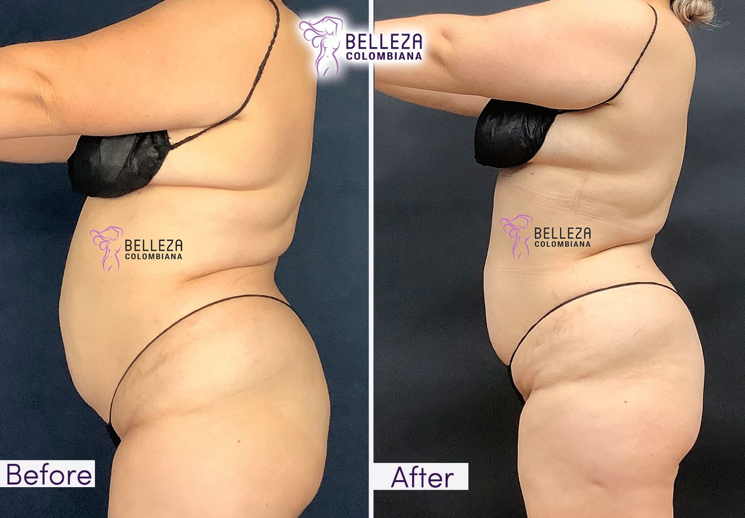 Body Countouring Before & After