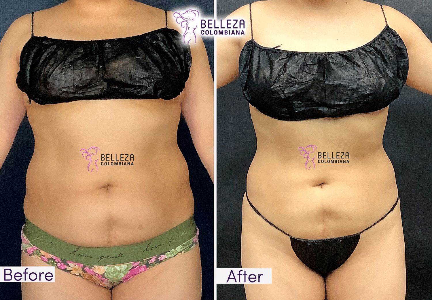 Body Countouring Before & After