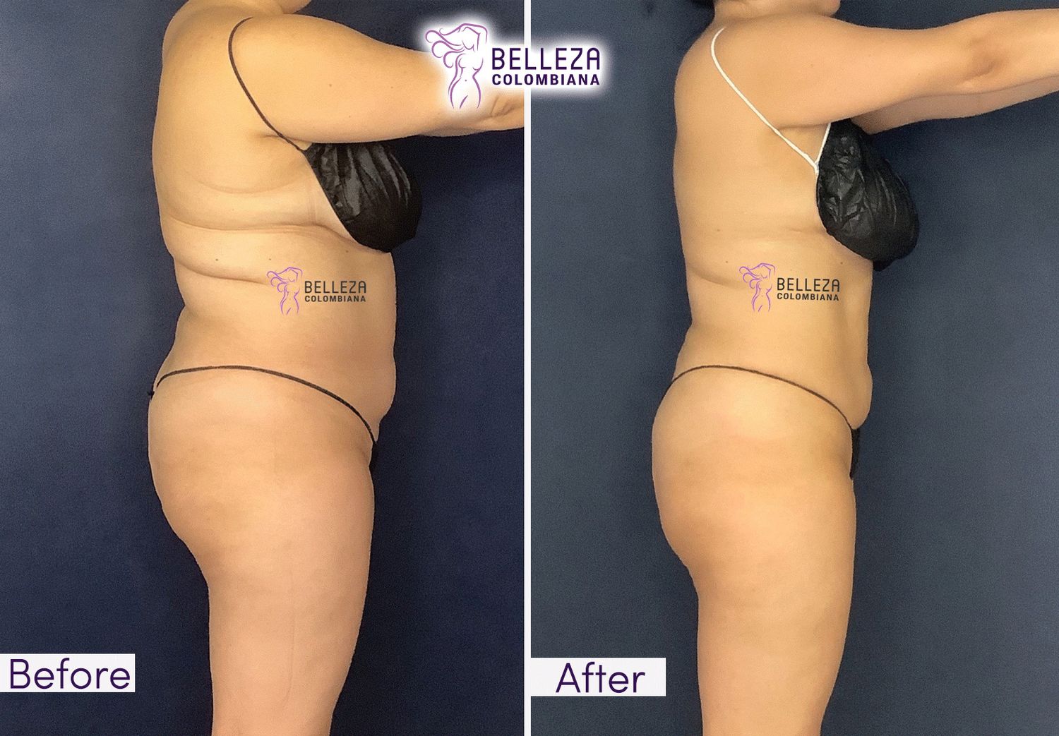 Body Countouring Before & After