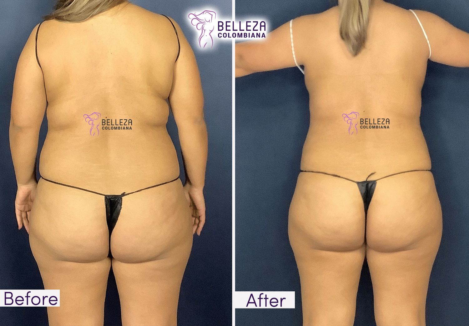 Body Countouring Before & After