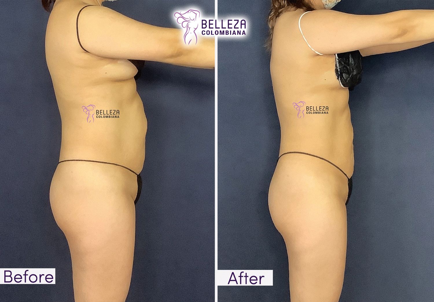 Body Countouring Before & After