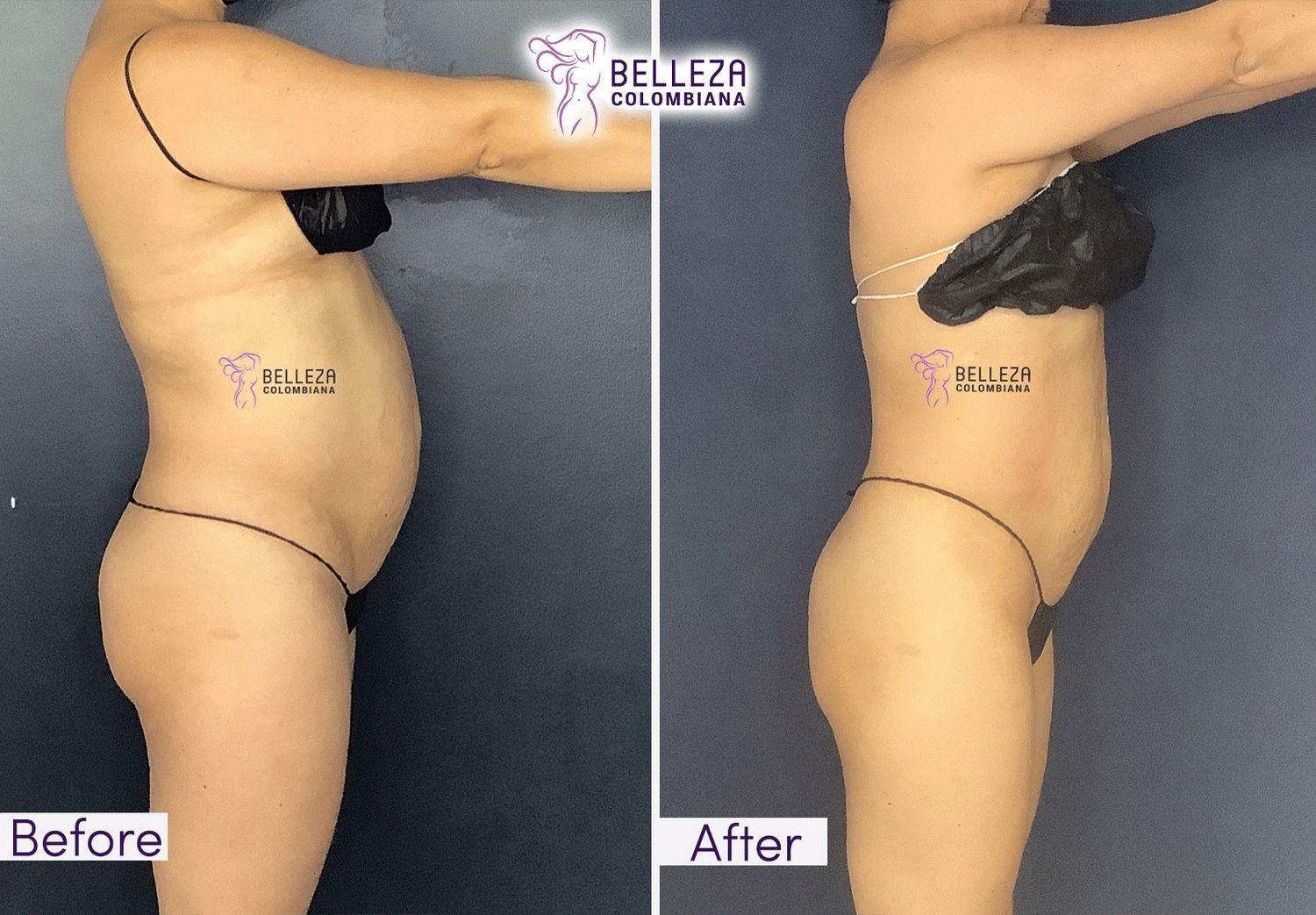 Body Countouring Before & After