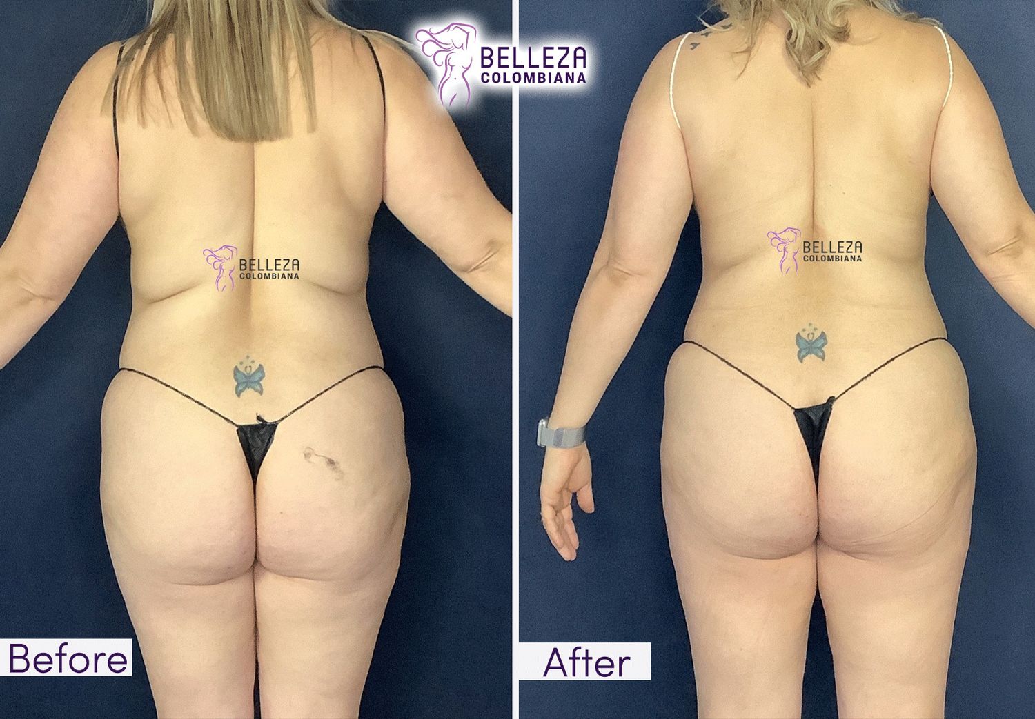 Body Countouring Before & After