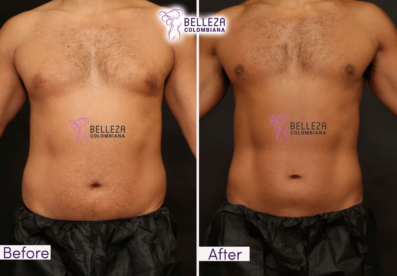 Body Countouring Before & After