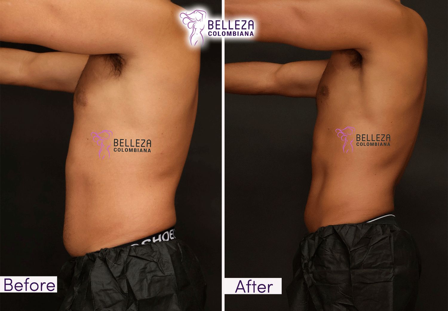 Body Countouring Before & After