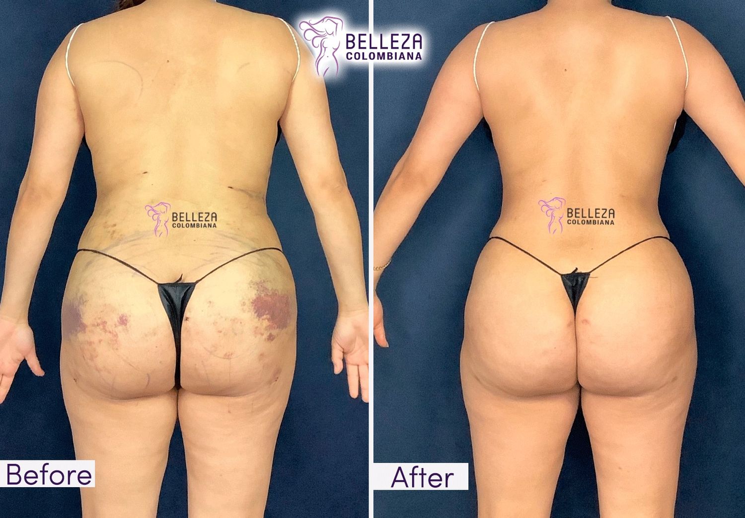 Post Op Before & After