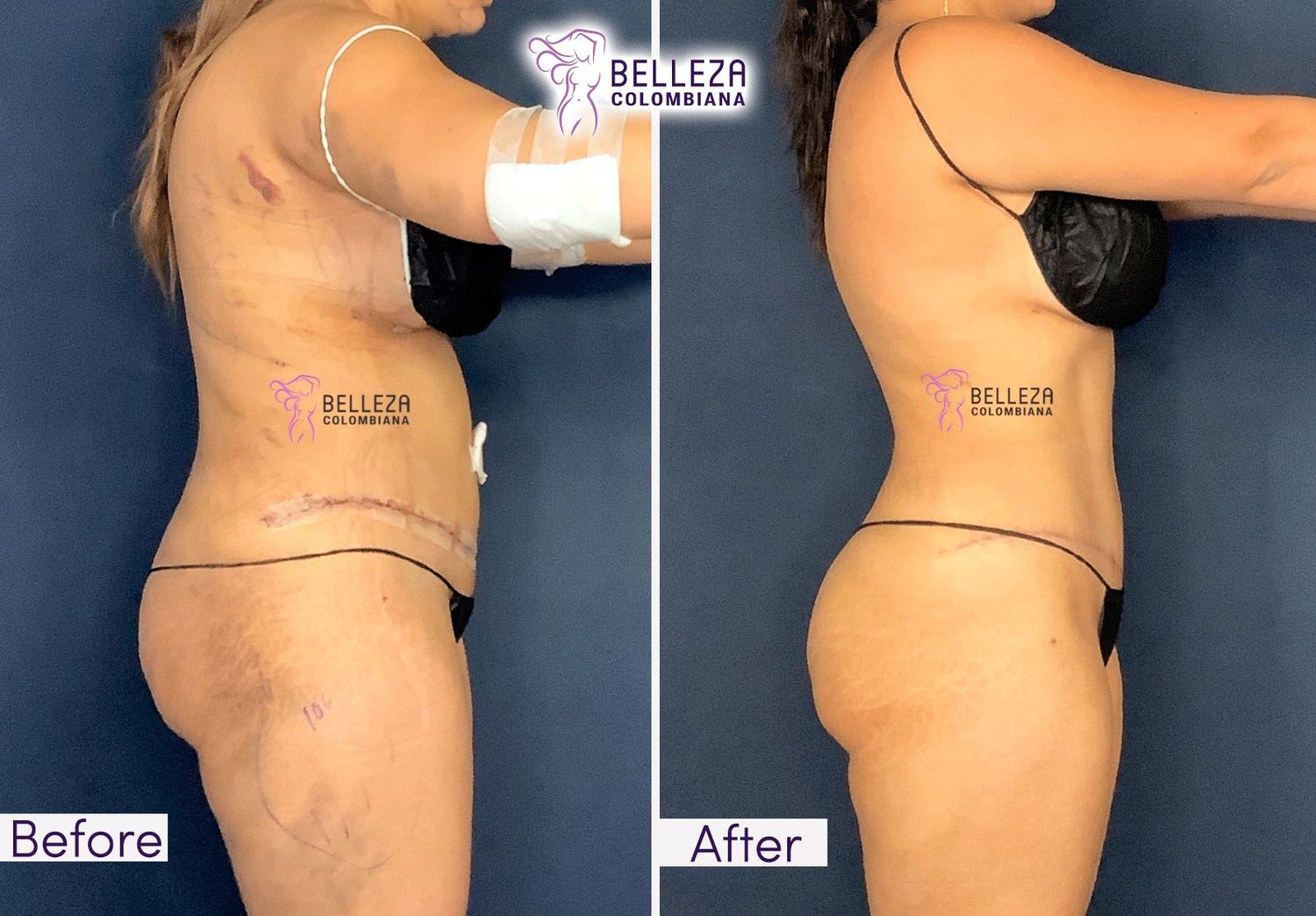 Post Op Before & After