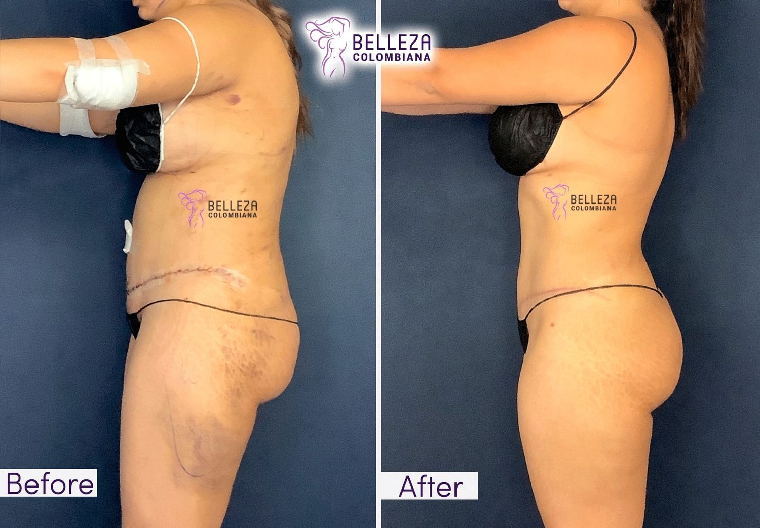 Post Op Before & After