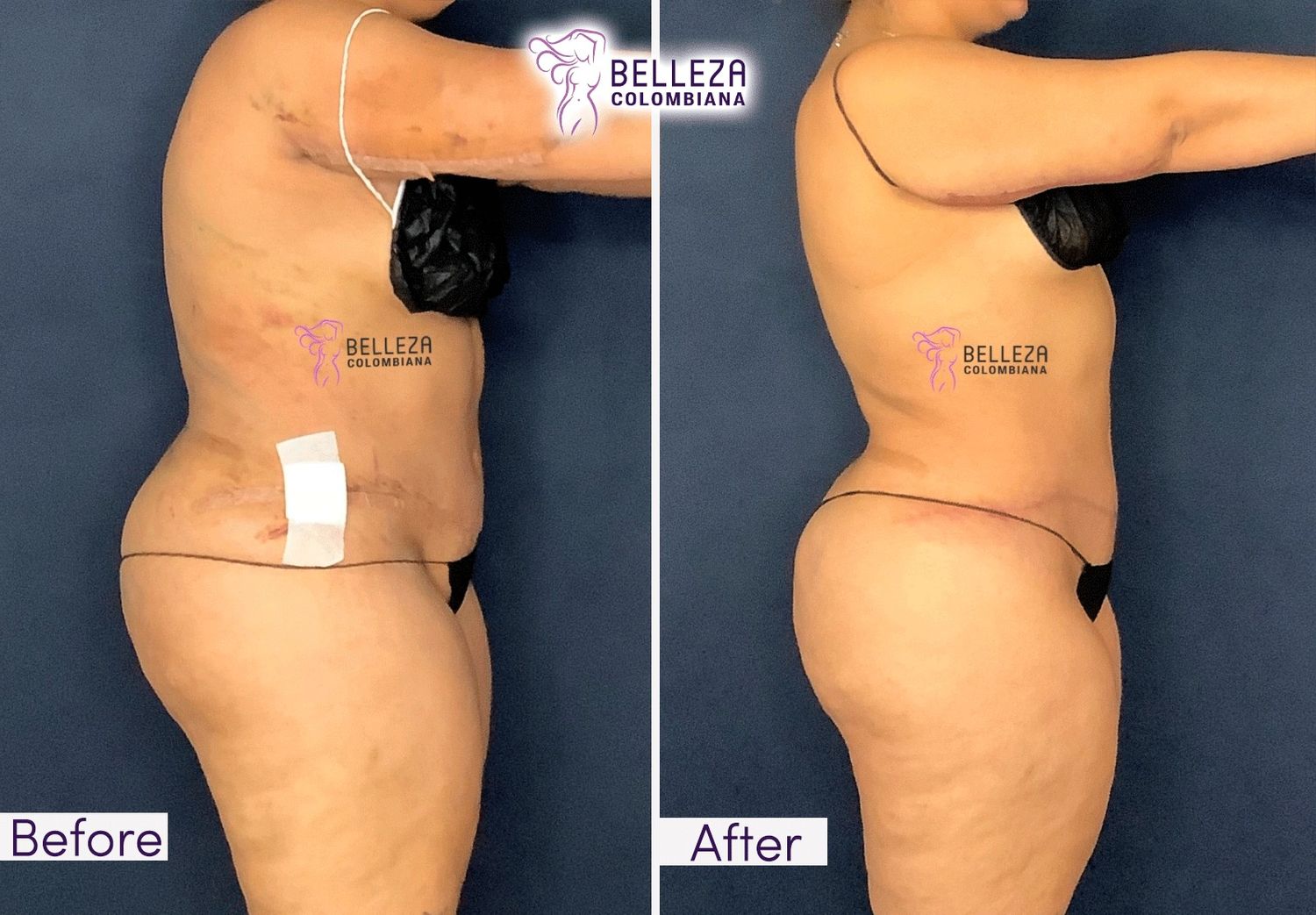 Post Op Before & After