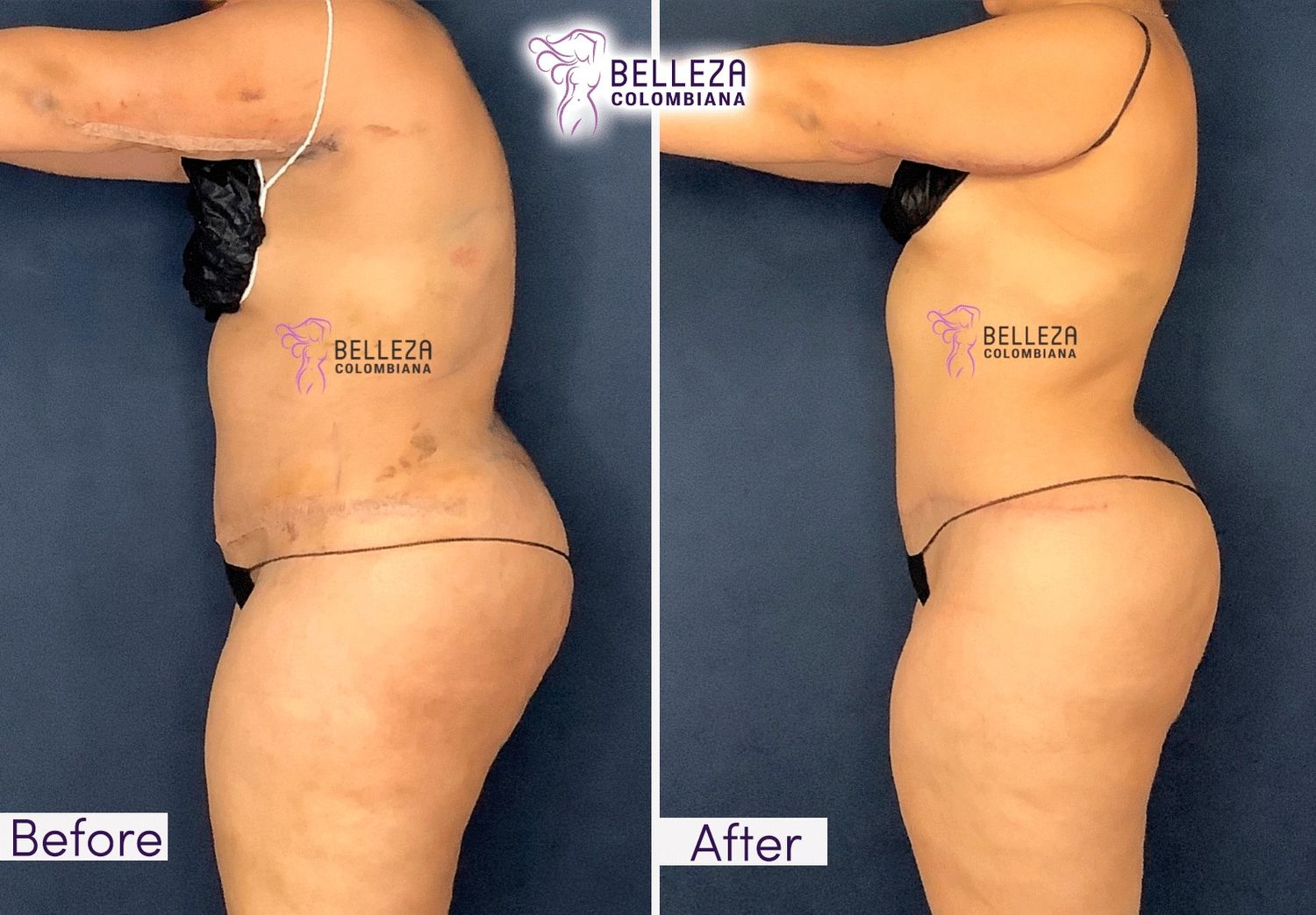 Post Op Before & After