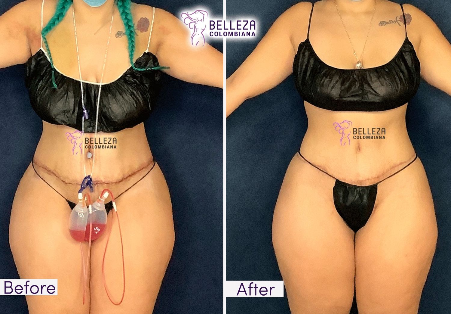 Post Op Before & After