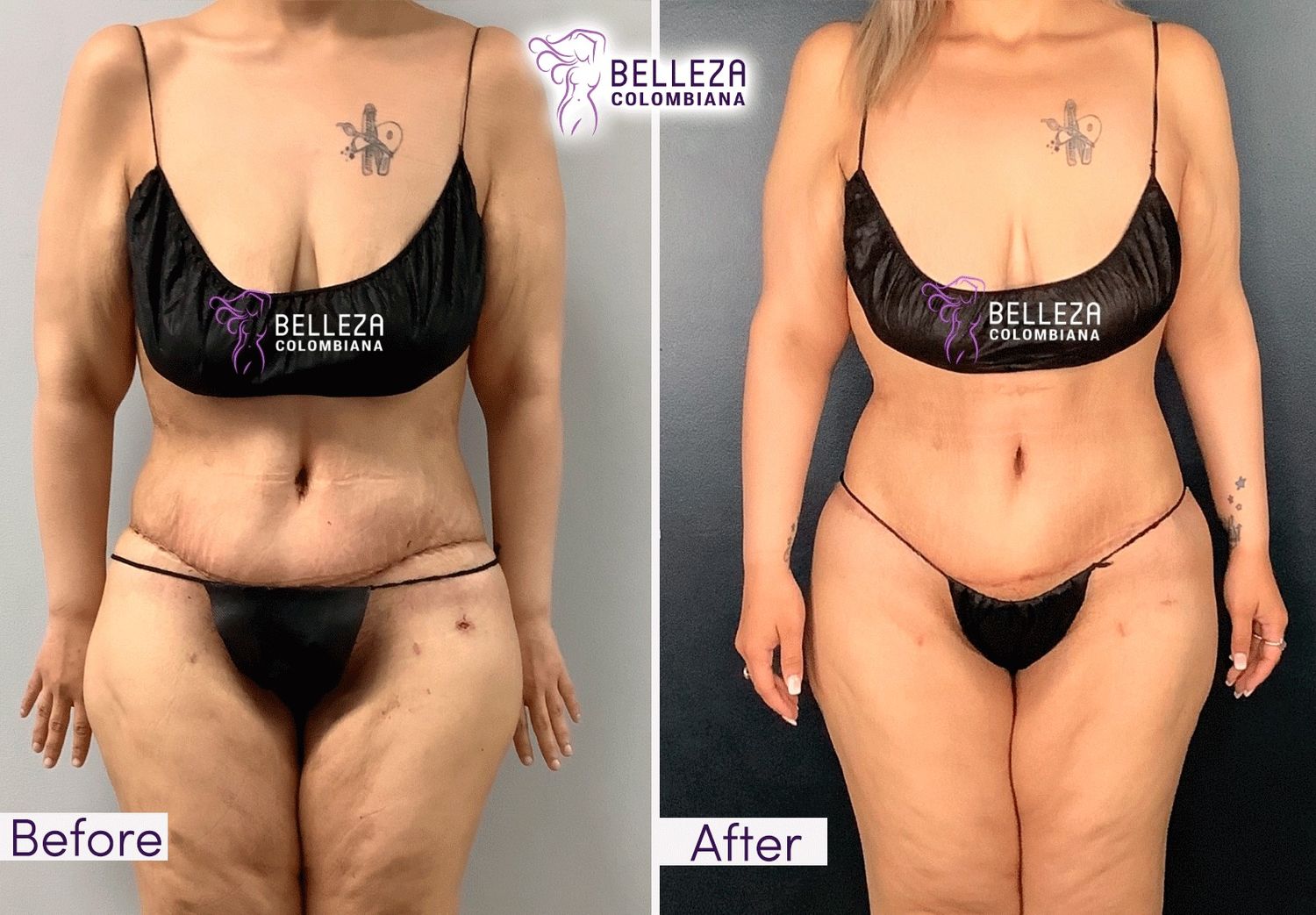 Post Op Before & After