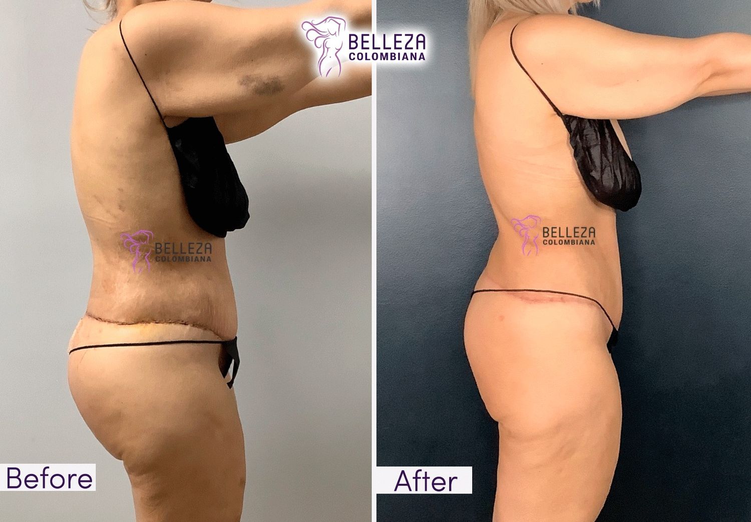 Post Op Before & After