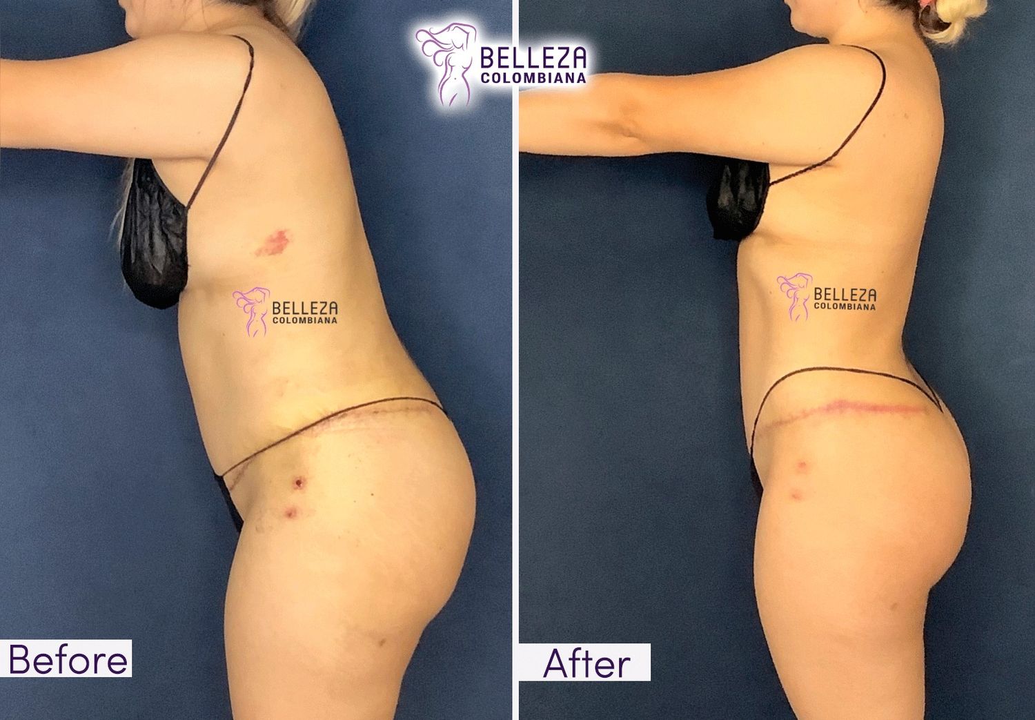 Post Op Before & After